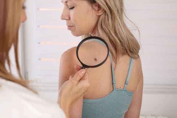 What Are Traditional Skin Lesion Removal Methods Cheshire?