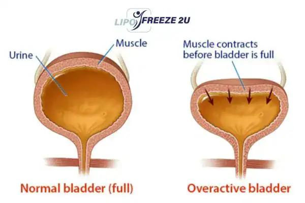 diagram of overactive bladder treatment Cheshire