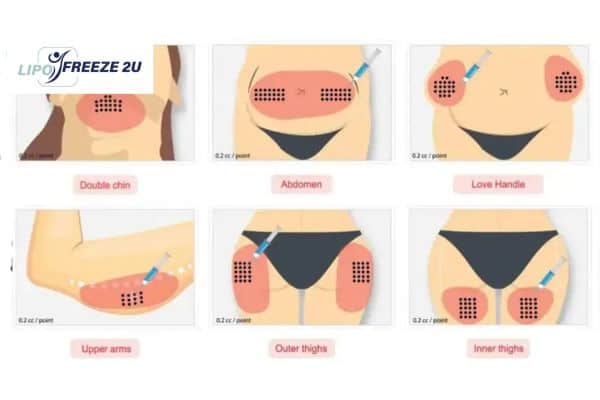 Benefits of Choosing Aqualyx for Fat Reduction Cheshire