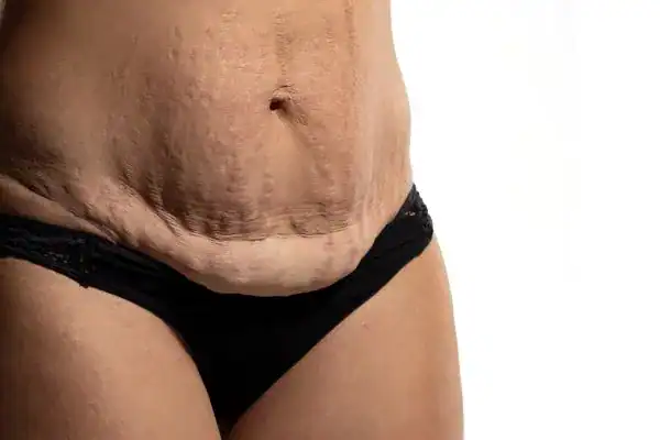 loose skin after weight loss injections Cheshire