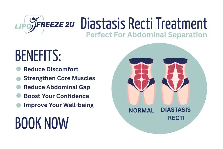Benefits of body toning treatment Cheshire for Diastasis recti