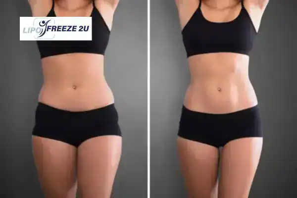 How Can LIPO FREEZE 2U Support Your Post-Pregnancy Body Recovery Cheshire?