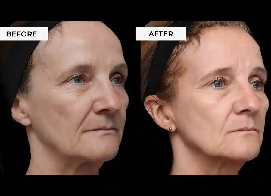 How Many RF Microneedling Sessions Will You Need to See a Difference Cheshire?