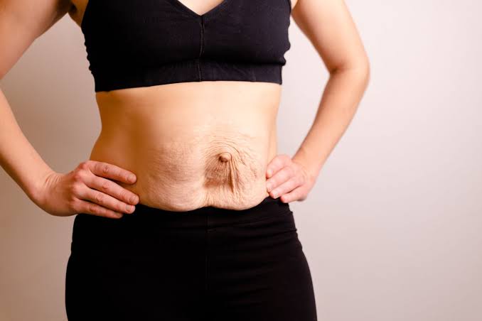 Is Surgery Really the Only Way to Repair Diastasis Recti Cheshire?