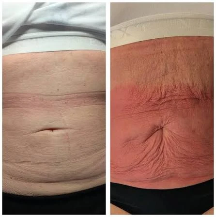How Does RF Microneedling Improve Crepey, Thin and Uneven Skin Texture Cheshire?
