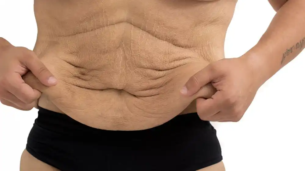 Why Does Weight Loss Medication Leave Some People With Loose or Sagging Skin Cheshire?